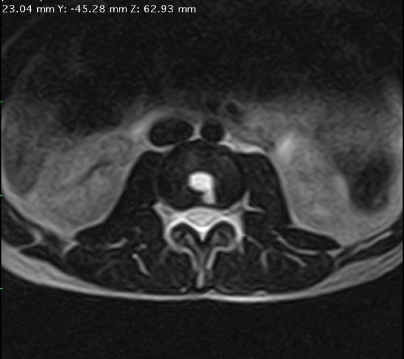 DISC ASPIRATION & BONE BIOPSY Dr Ahmad Zia